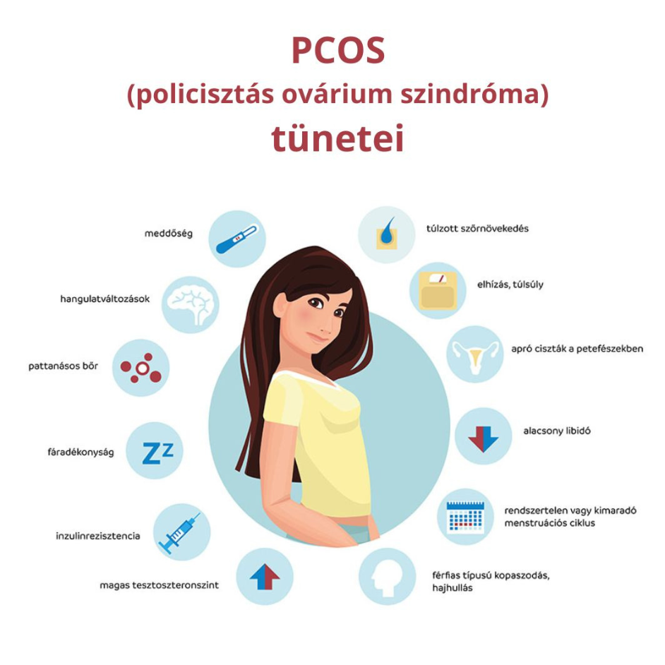 PCOS (policisztás ovárium szindróma) tünetei és kezelése